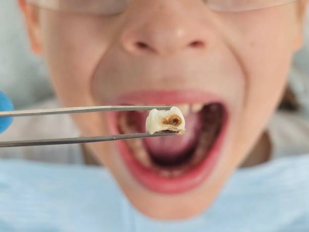 Best Broken or Chipped Tooth Repair in Smithville, TX